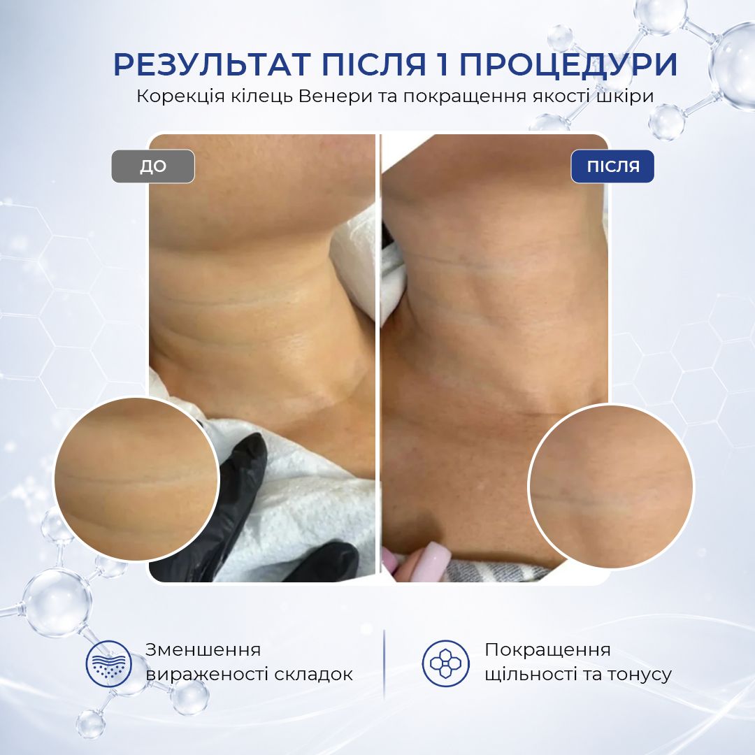 До та після PYDCOLEX: клінічний приклад для зони шиї
