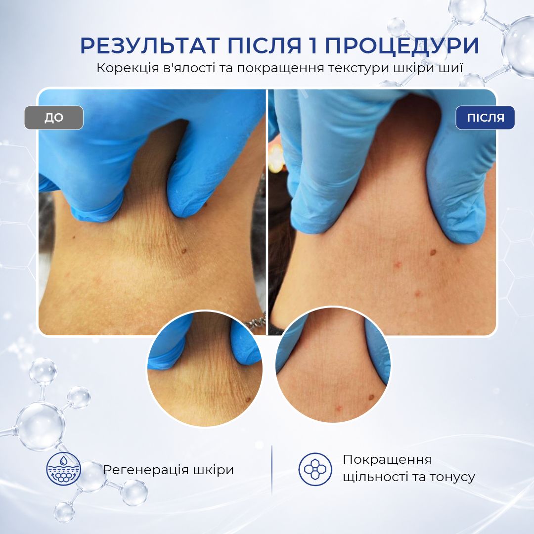 До та після PYDCOLEX: робота з текстурою шкіри шиї